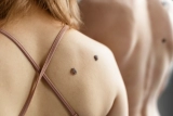 How to Remove Skin Tags in One Night Without Pain